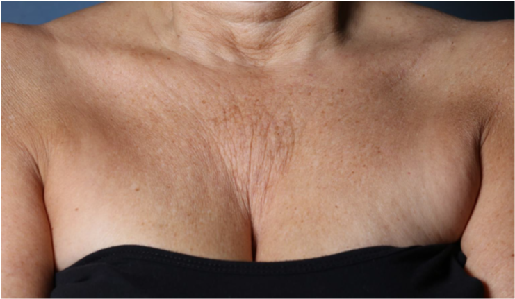 Close-up of the décolleté area showing lines, wrinkles and crepiness evaluated in the study
